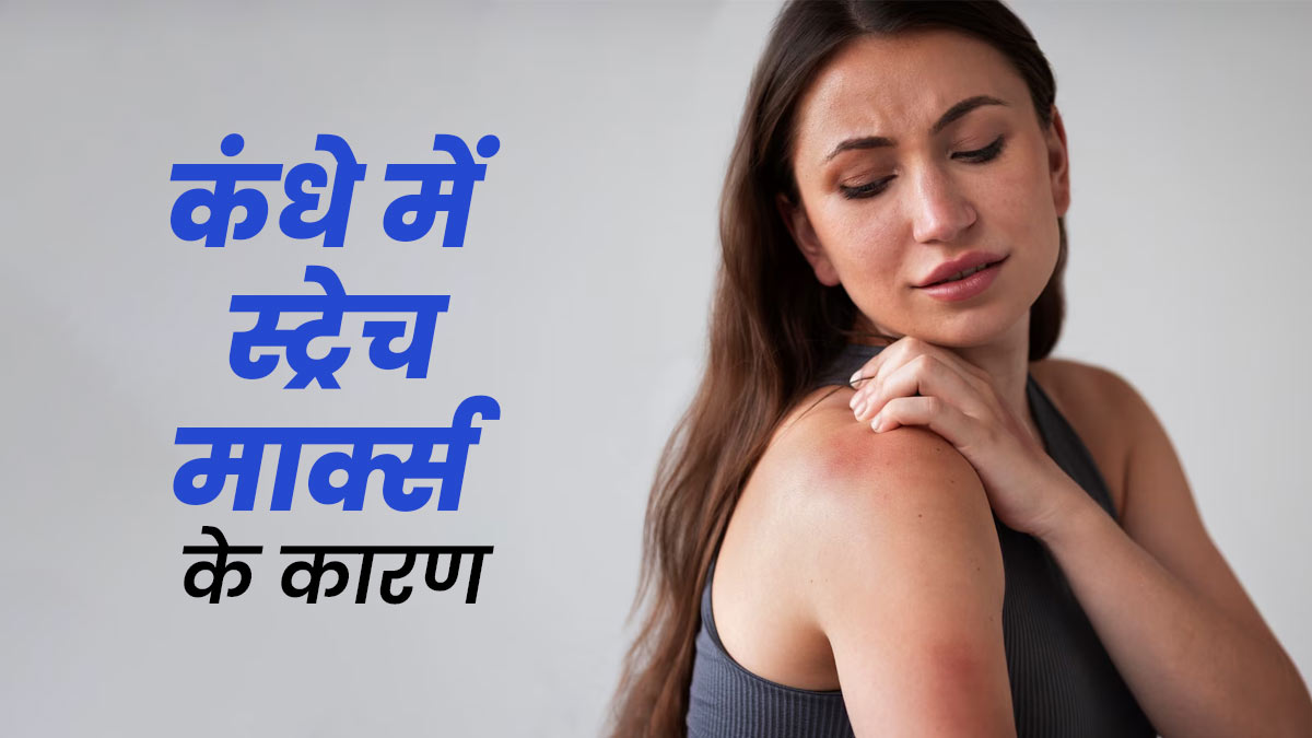 क्या आपके कंधे पर भी हैं स्ट्रेच मार्क्स? जानें इसके कारण और छुटकारा पाने के टिप्स
