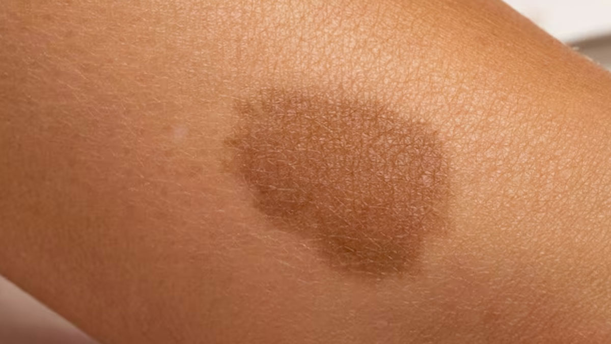 can we remove birthmark in hindi 01 (5)