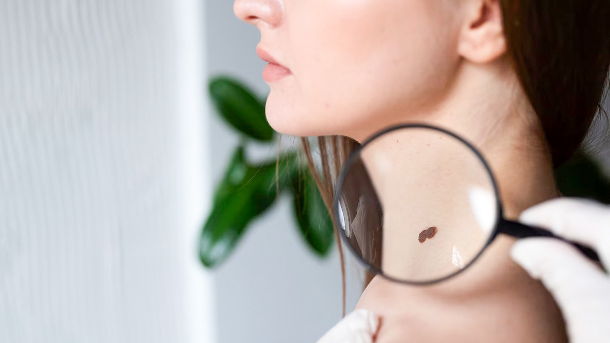 can we remove mole from face in hindi 1 (5)