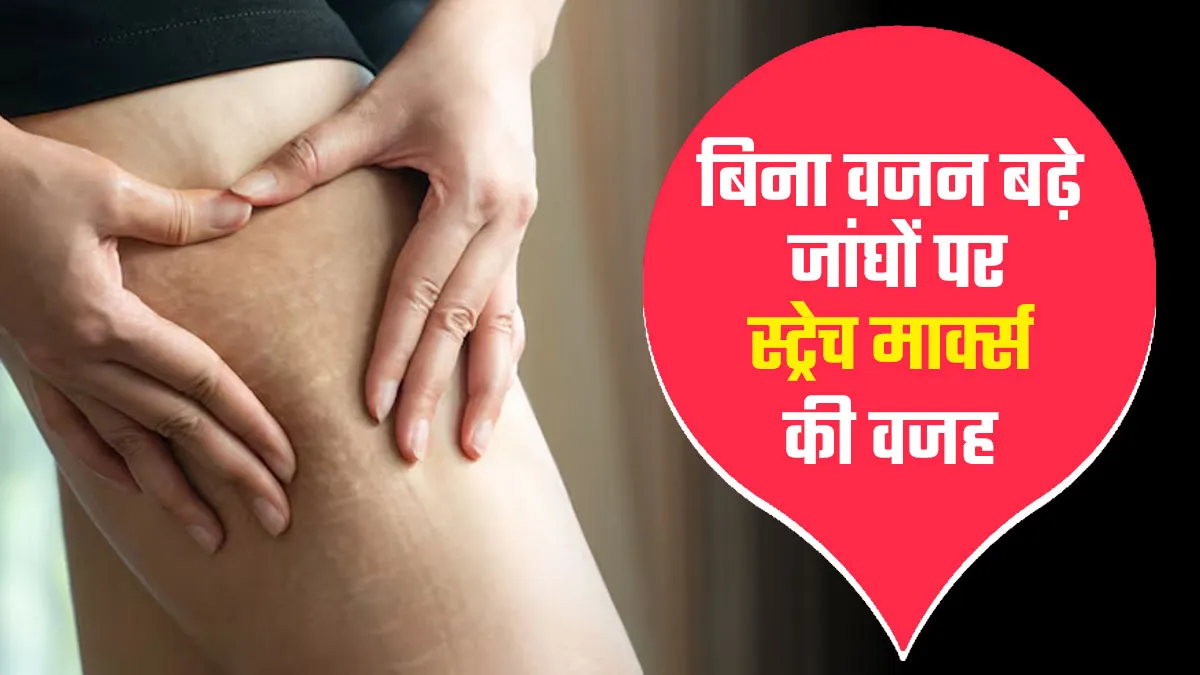 बिना वजन बढ़े जांघों पर स्ट्रेच मार्क्स क्यों हो जाते हैं? जानें कारण और बचाव