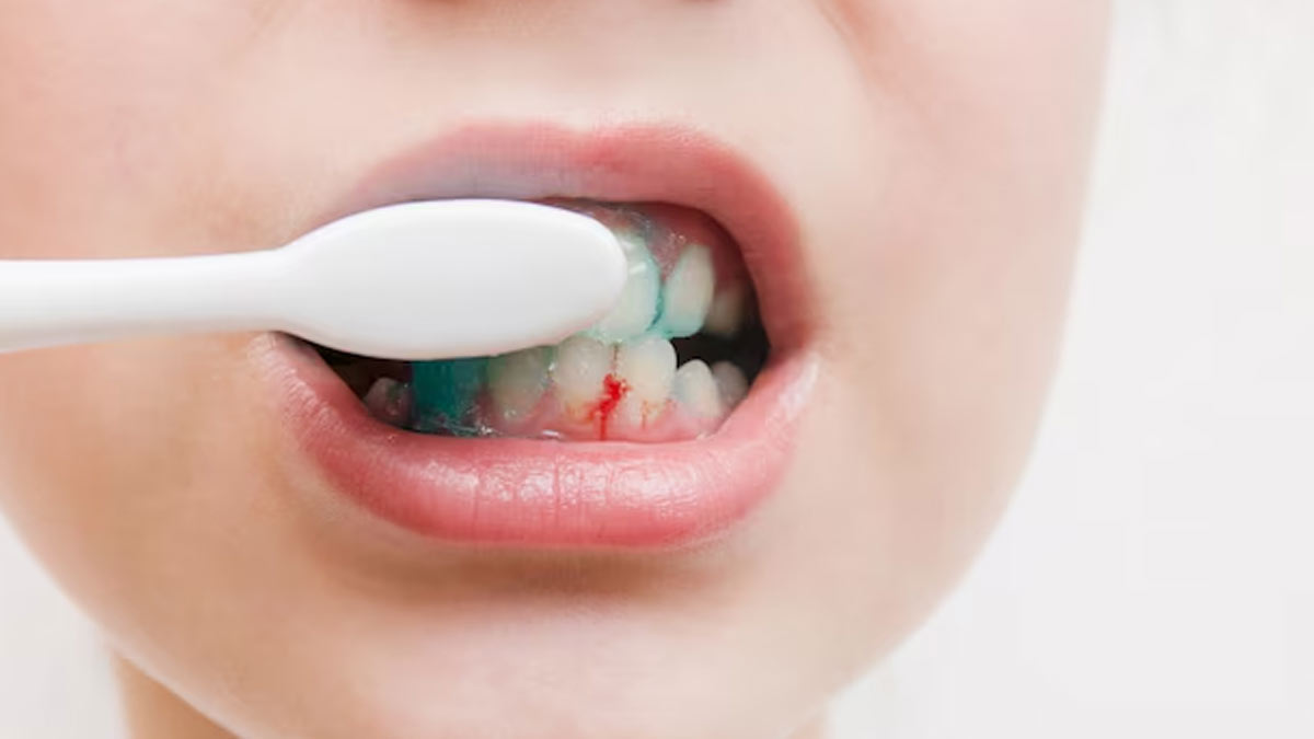 Are bleeding gums normal