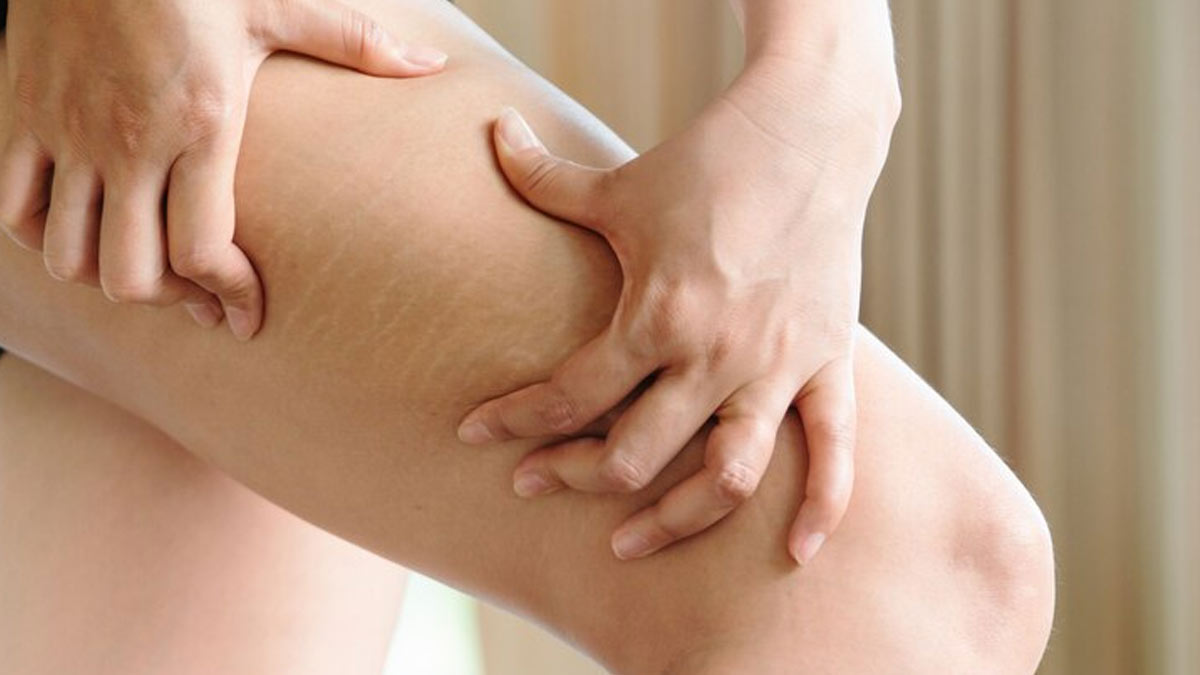 stretch marks without weight gain