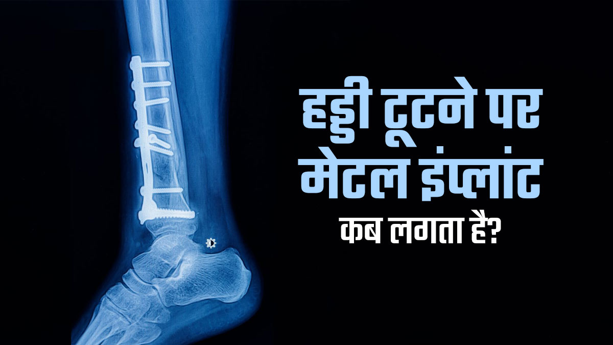 हड्डी टूटने पर मेटल इंप्लांट की जरूरत कब पड़ती है? डॉक्‍टर से जानें