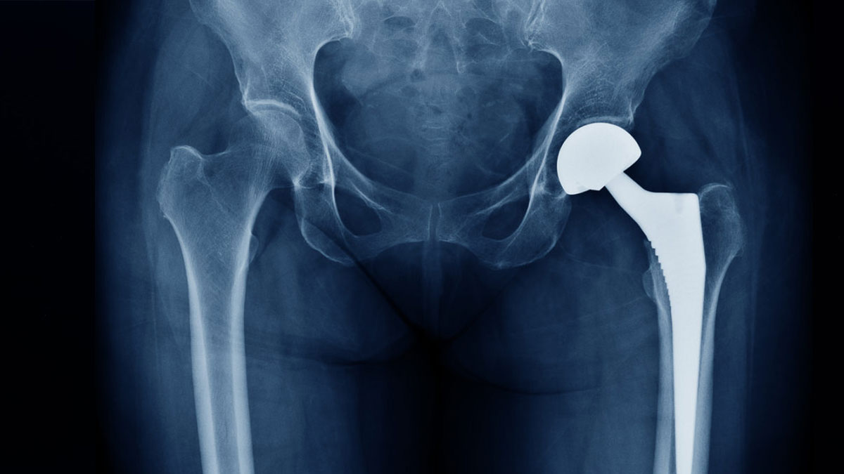 bone-implant-in-hindi