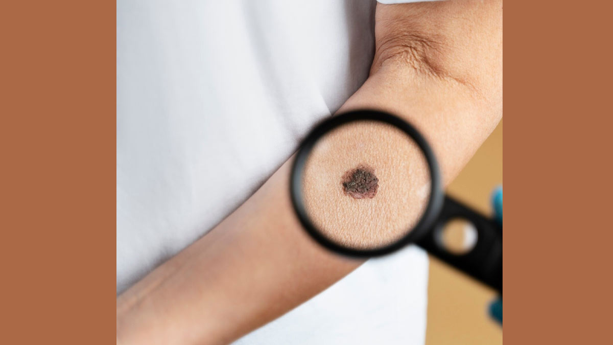 can a birthmark turn cancerous 01 (5)