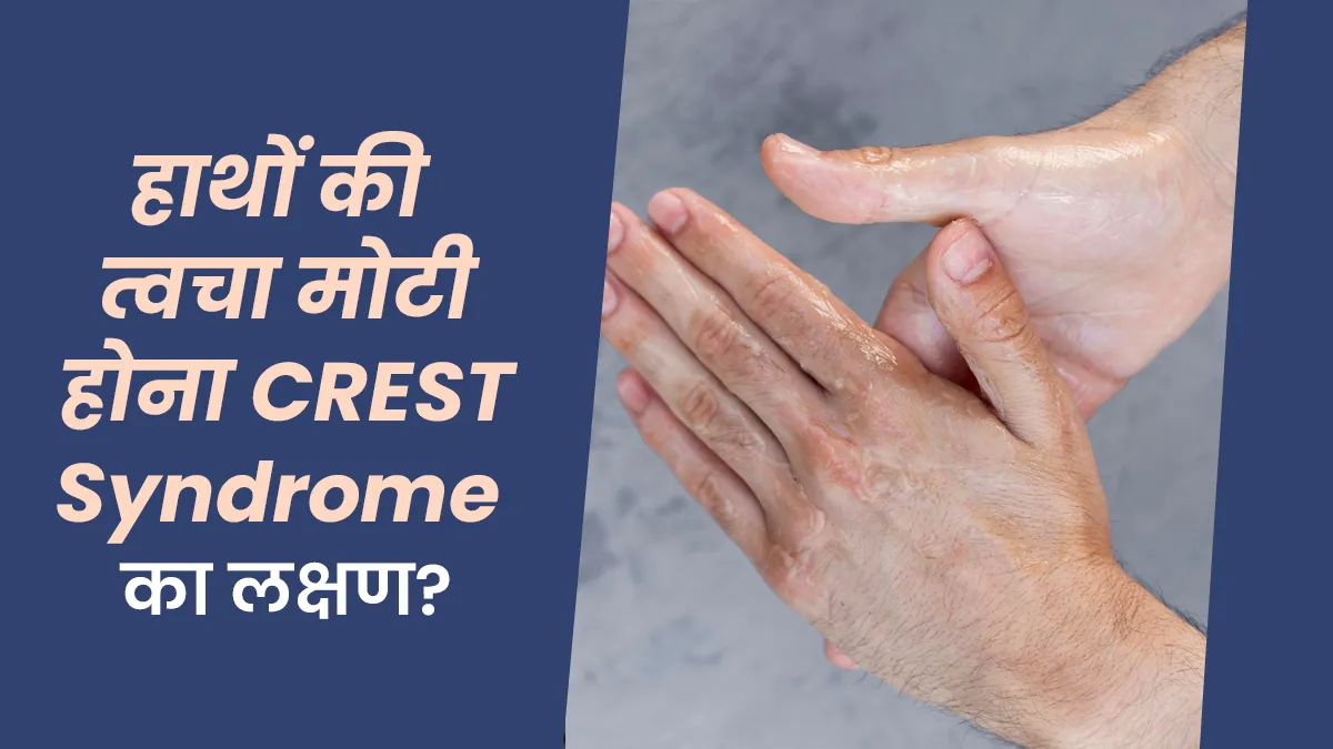 क्या हाथों की त्वचा मोटी होना CREST Syndrome तो नहीं? जानें डॉक्टर से इसके लक्षण