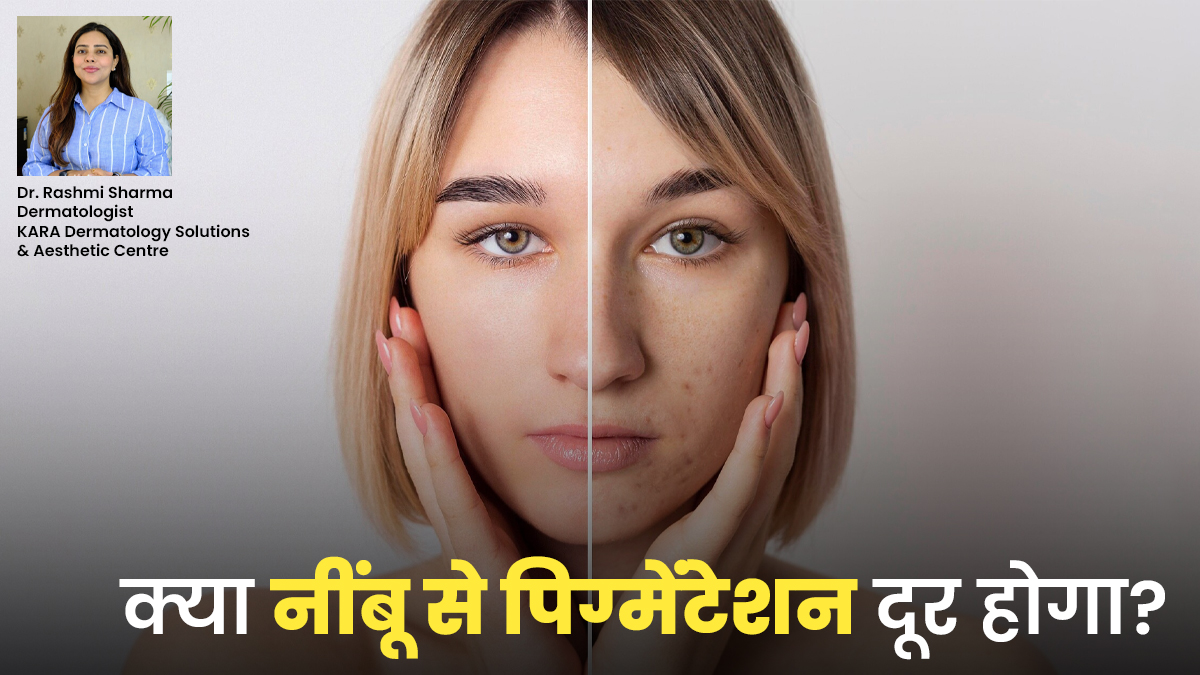 क्या नींबू से पिग्मेंटेशन की समस्या सच में दूर होती है? डर्मेटोलॉजिस्ट से जानें