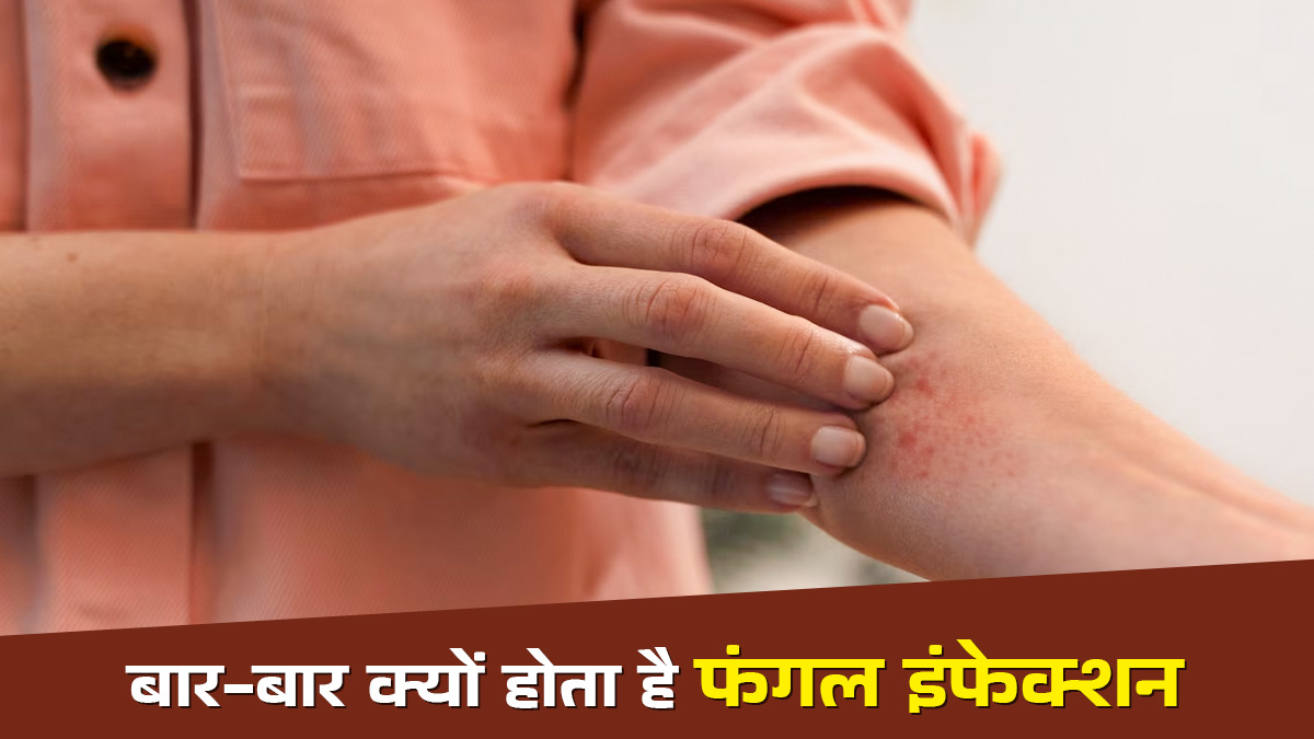 बार-बार होने वाले फंगल इन्फेक्शन का क्या कारण है? खुद एक्सपर्ट ने बताया