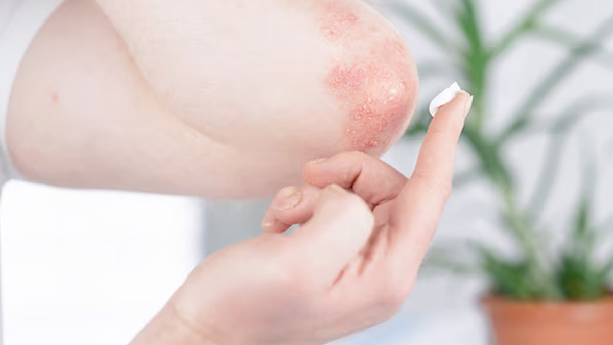 recurrent fungal infection