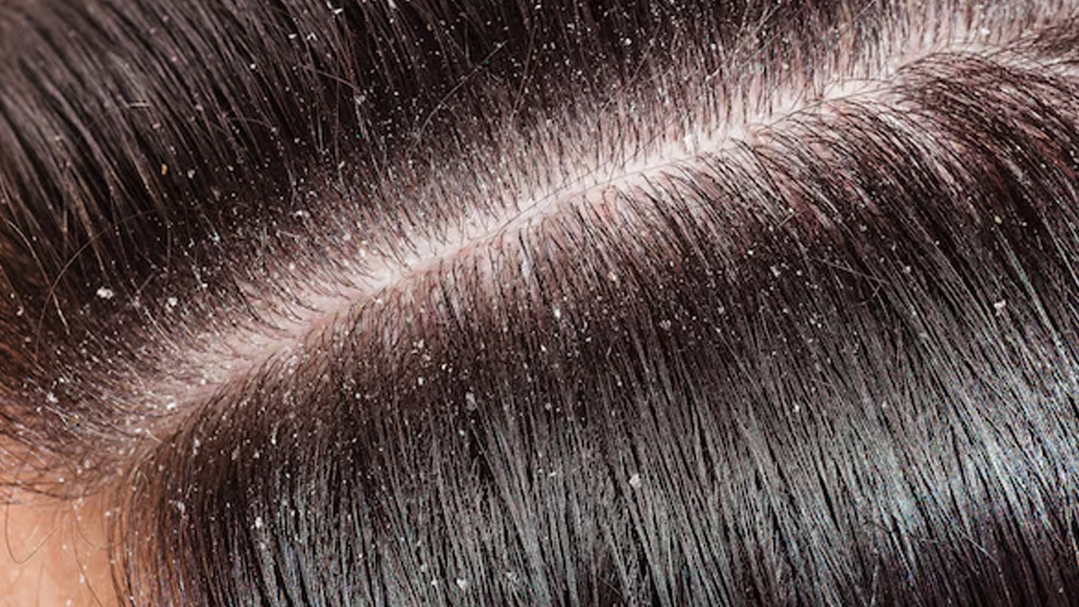 how-to-deal-with-dandruff-in-changing-weather