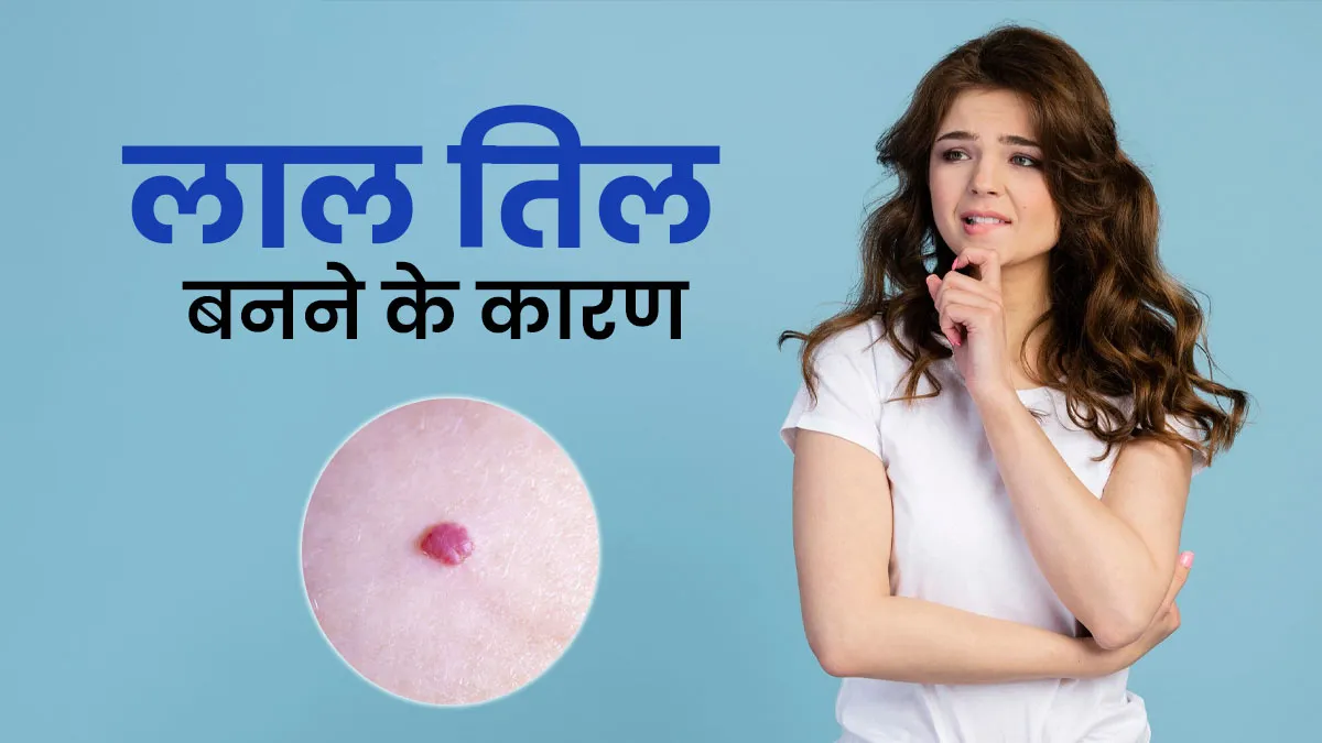 शरीर पर लाल तिल क्यों बनते हैं? जानें डॉक्टर से इसके कारण और इलाज
