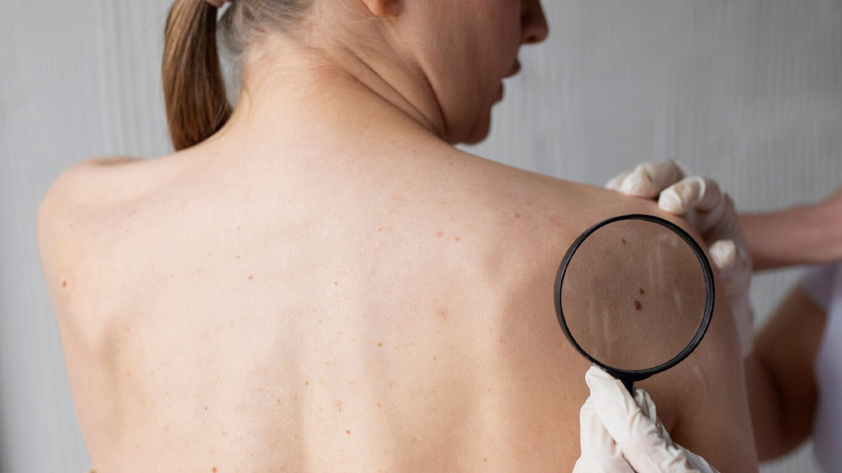 causes of red moles on skin