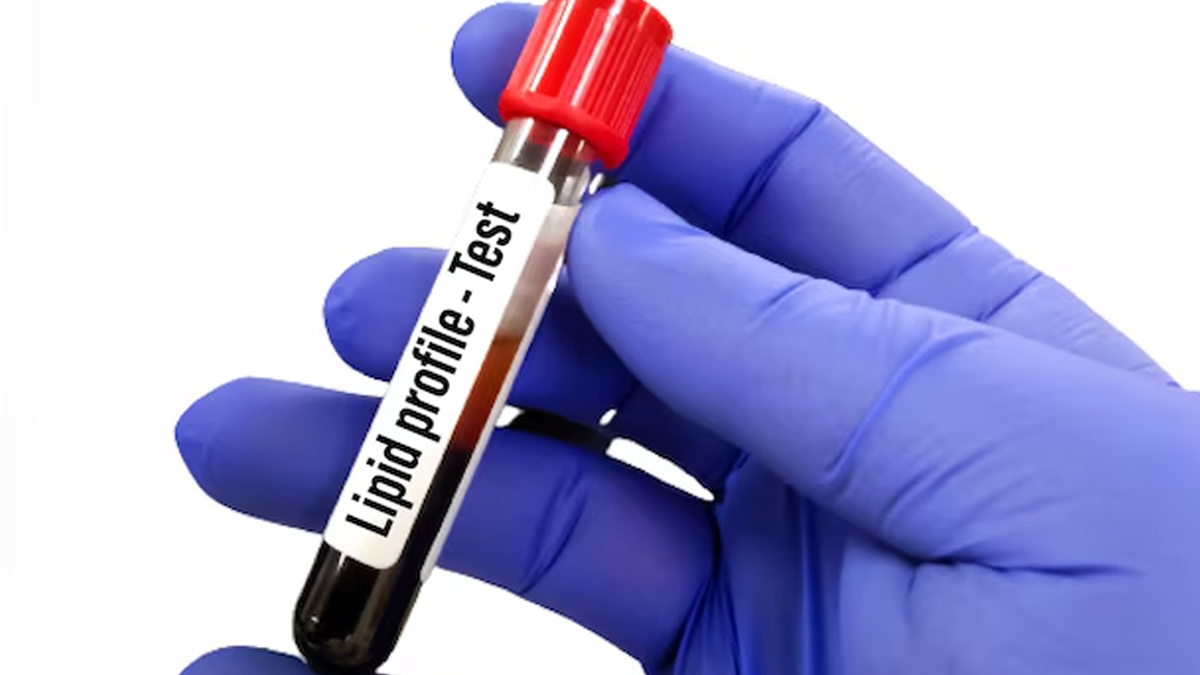 lipid-profile-test