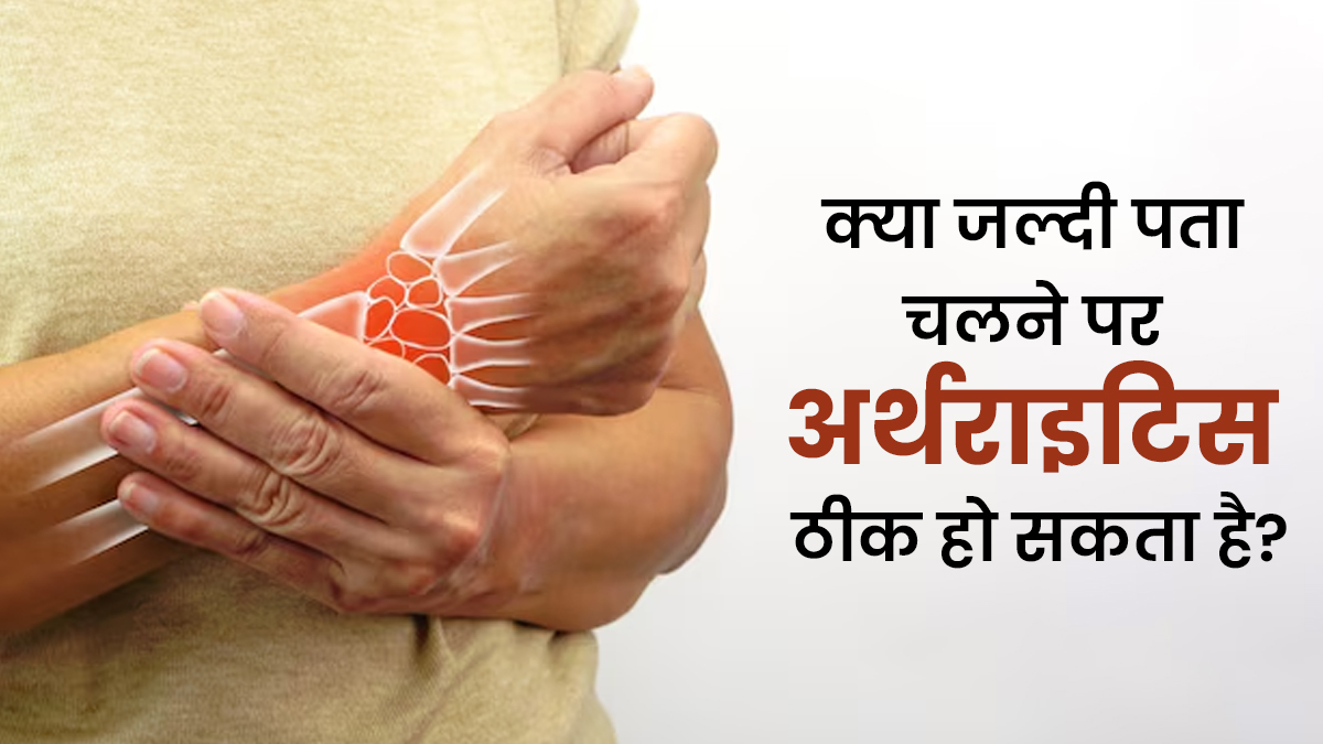 क्या जल्दी पता चलने पर अर्थराइटिस पूरी तरह ठीक हो सकता है? जानें क्या कहते हैं डॉक्टर