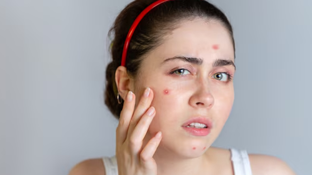 excessive consumption of sugar can cause skin problems in hindi 1