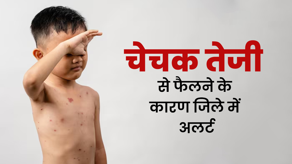 केरल के कोल्लम जिले में तेजी से फैल रहा चेचक (चिकनपॉक्स), स्वास्थ्य विभाग ने जारी किया अलर्ट