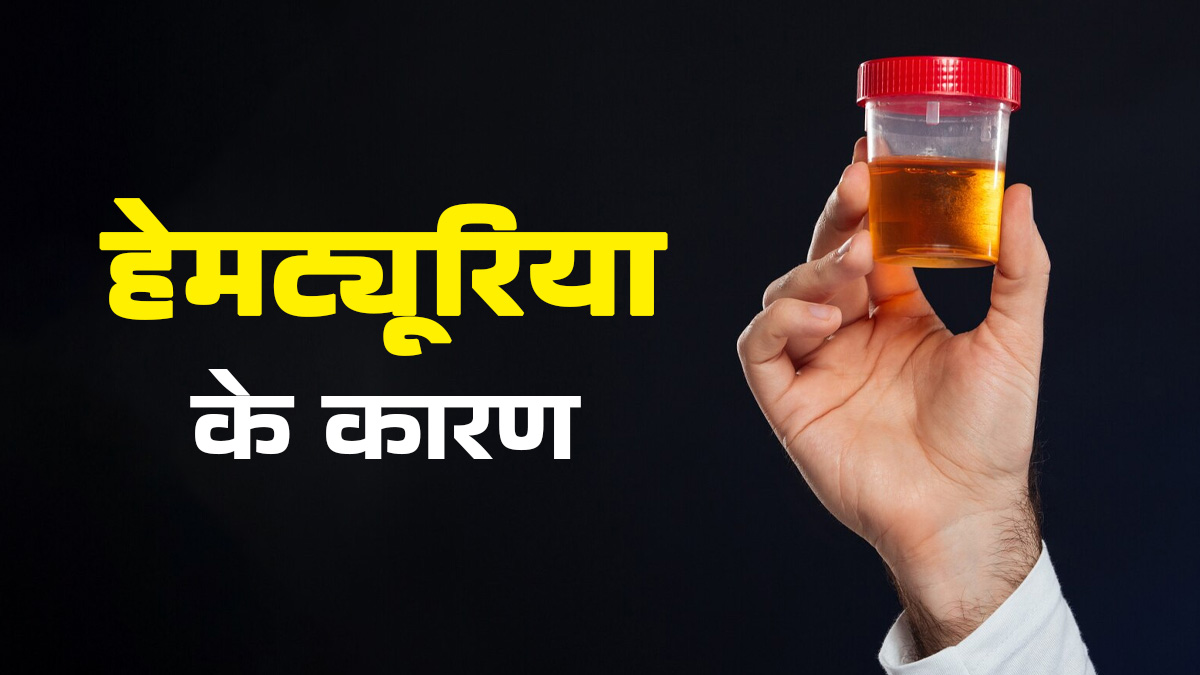 हेमट्यूरिया का क्या कारण है? डॉक्टर से जानें