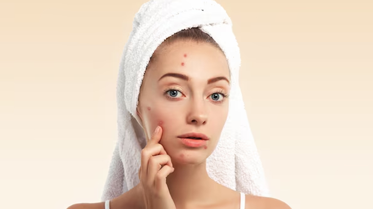 Causes-of-Acne-in-Changing-Weather-inside