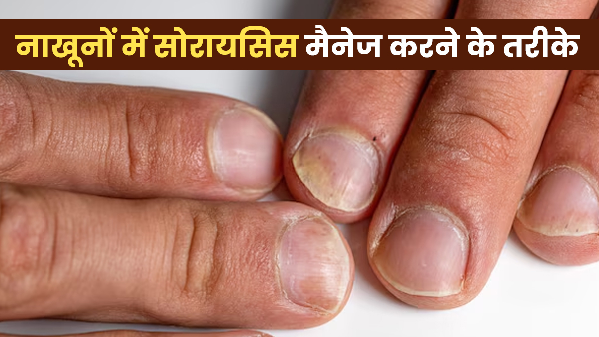 नाखून में सोरायसिस होने पर कैसे करें मैनेज? डॉक्टर से जानें तरीके
