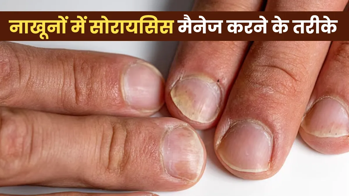 नाखून में सोरायसिस होने पर कैसे करें मैनेज? डॉक्टर से जानें तरीके
