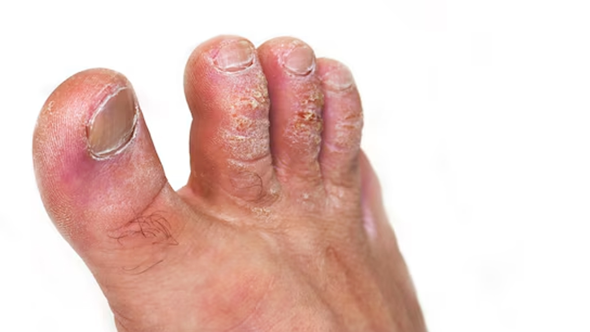 psorasis in nails in hindi doctor