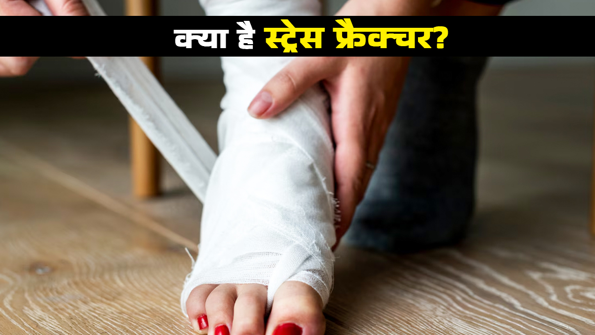 क्या है स्ट्रेस फ्रैक्चर? जिसमें बार-बार दबाव से टूट सकती है हड्डी, डॉक्टर से जानें