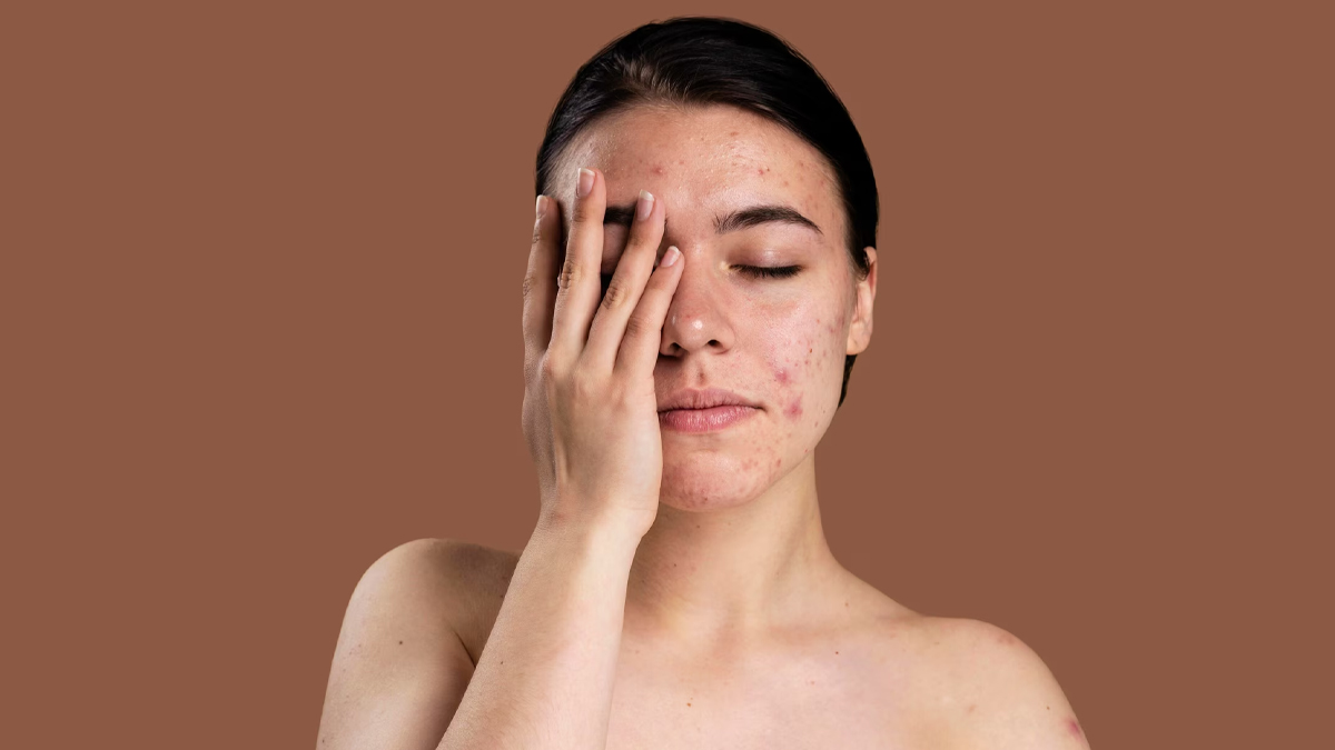 Does spicy food affect skin