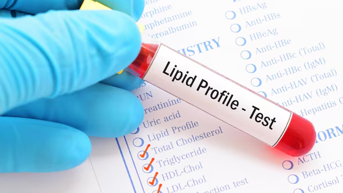 lipid-profile-test