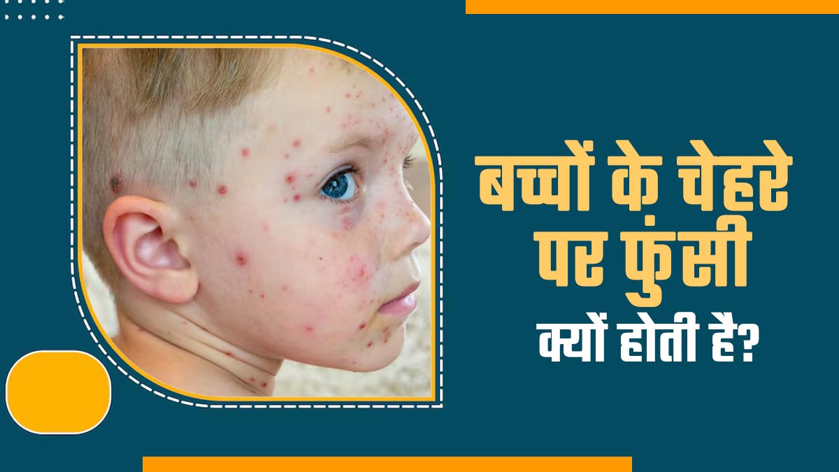 बच्चों के चेहरे पर हो रही है फुंसी? हो सकते हैं ये कारण डॉक्टर से जानें