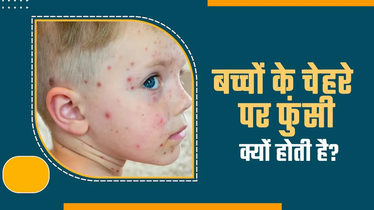 बच्चों के चेहरे पर हो रही है फुंसी? हो सकते हैं ये कारण डॉक्टर से जानें