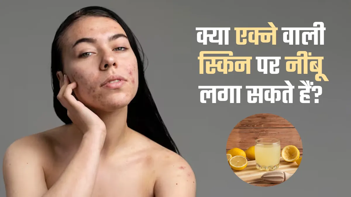 क्या एक्ने वाली स्किन पर नींबू लगाना सुरक्षित है? डर्मेटोलॉजिस्ट से जानें
