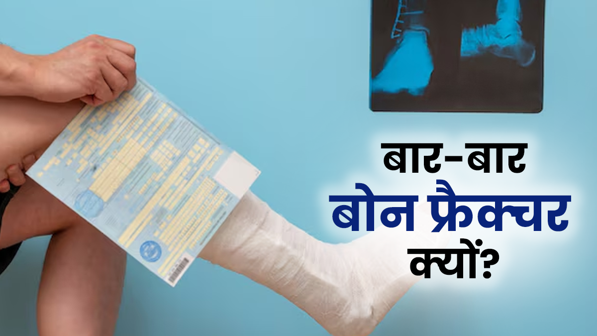 बार-बार हड्डी का फ्रैक्‍चर होना नहीं है सामान्‍य, डॉक्‍टर से जानें कारण
