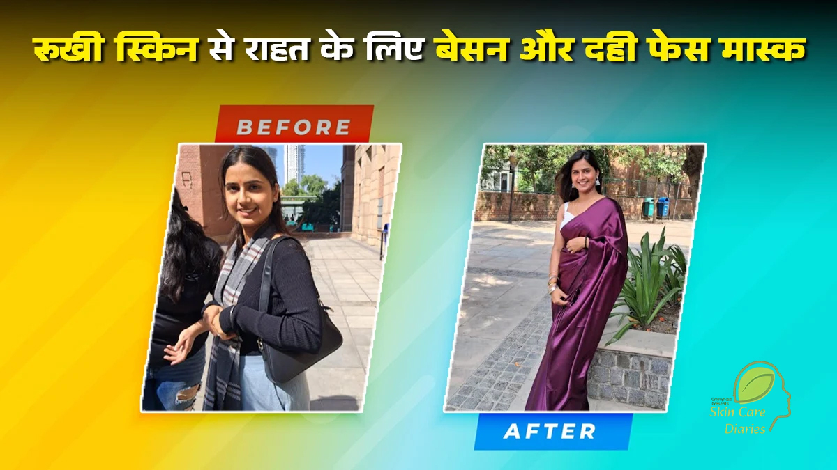 दही और बेसन के इस जादुई फेस मास्क से सुरभि ने पाई रूखी बेजान स्किन से राहत