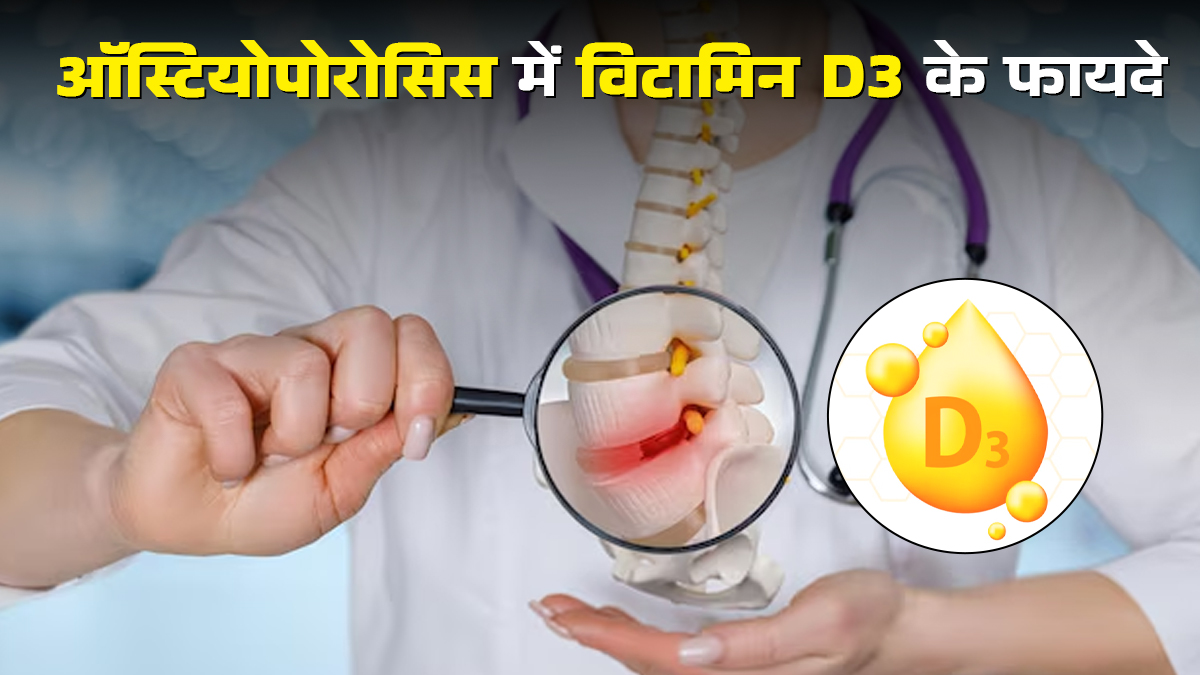 Vitamin D3: चटकती हड्डियों का सहारा है ये विटामिन, जानें ऑस्टियोपोरोसिस के मरीजों के लिए क्यों है जरूरी