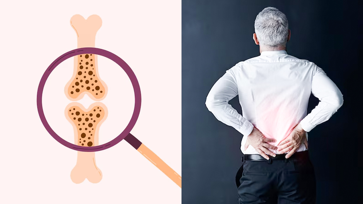 ऑस्टियोपोरोसिस से कौन सी हड्डियां सबसे ज्यादा टूटती हैं? जानकर हो सकती है आपको भी हैरानी