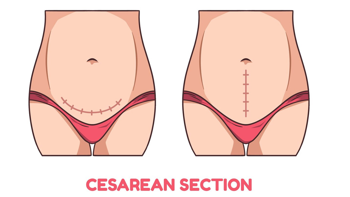 is it safe to eat spicy food after c section 1 (5)