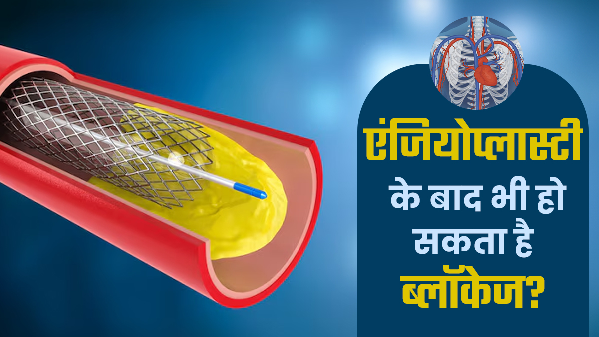 क्या एंजियोप्लास्टी के बाद ब्लॉकेज दोबारा हो सकता है? डॉक्टर से जानें