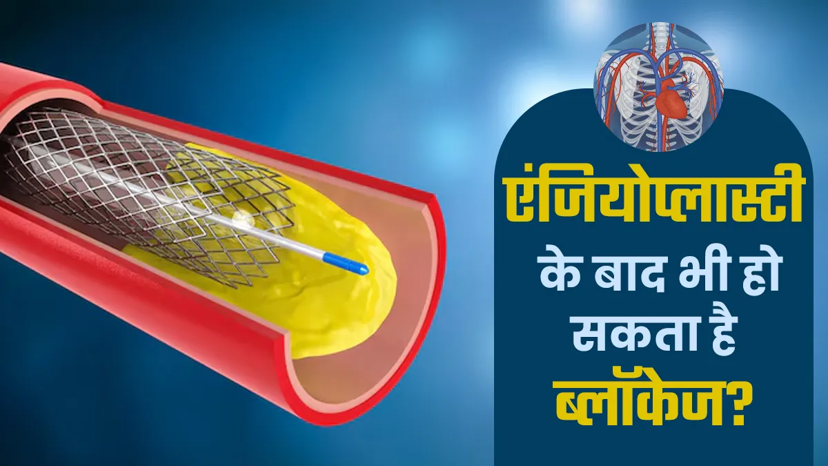 क्या एंजियोप्लास्टी के बाद ब्लॉकेज दोबारा हो सकता है? डॉक्टर से जानें