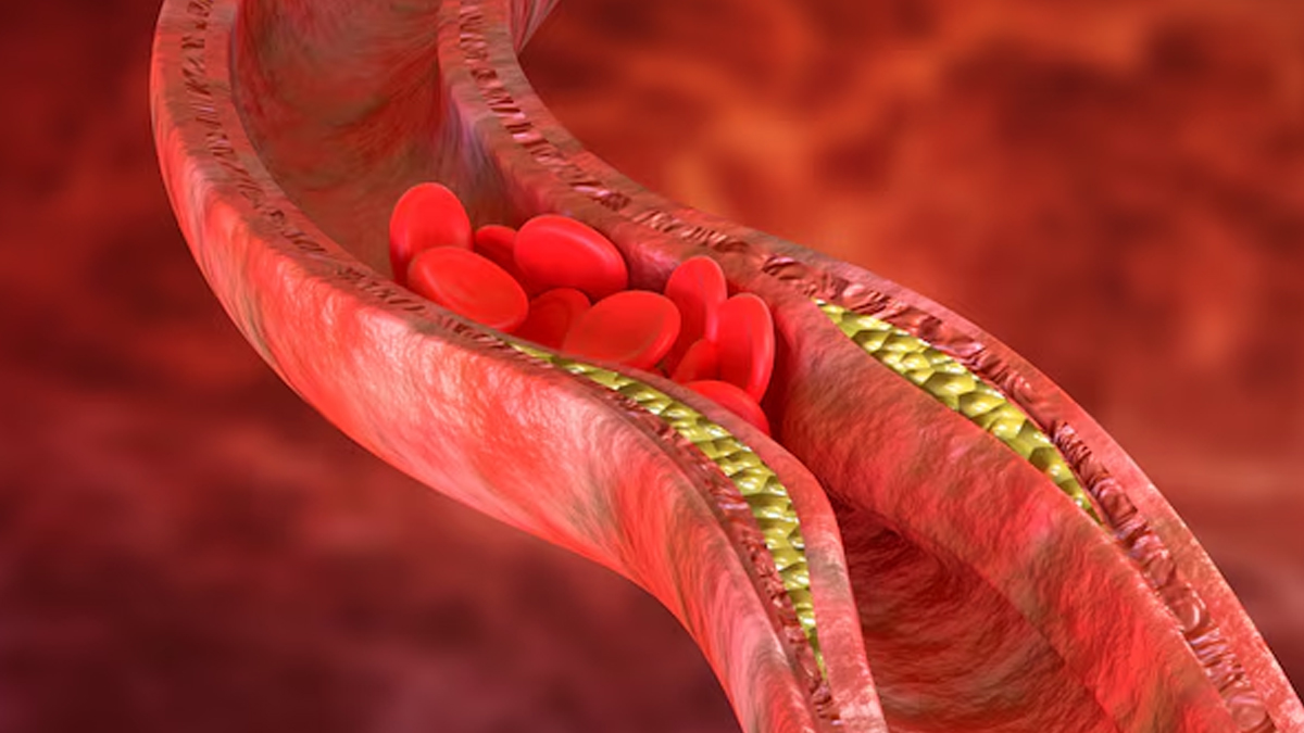 Heart blockage after angioplasty
