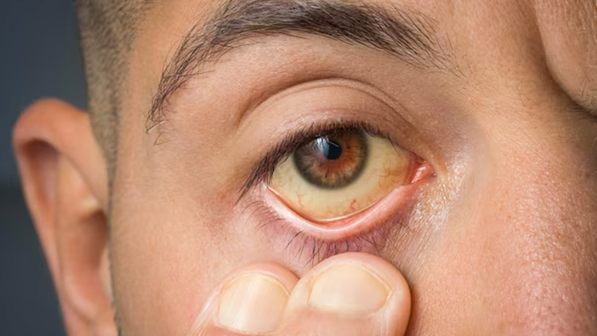 Does fatty liver cause jaundice