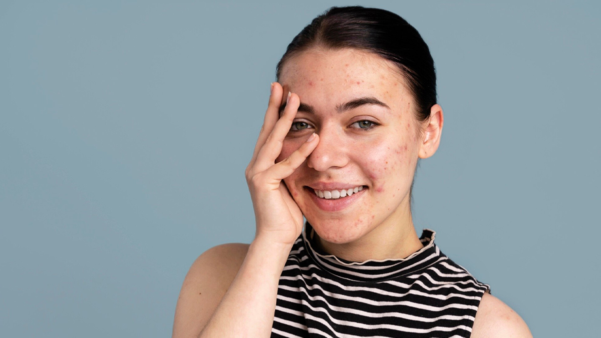 how many times should you wash your face if you have acne 01 (11)