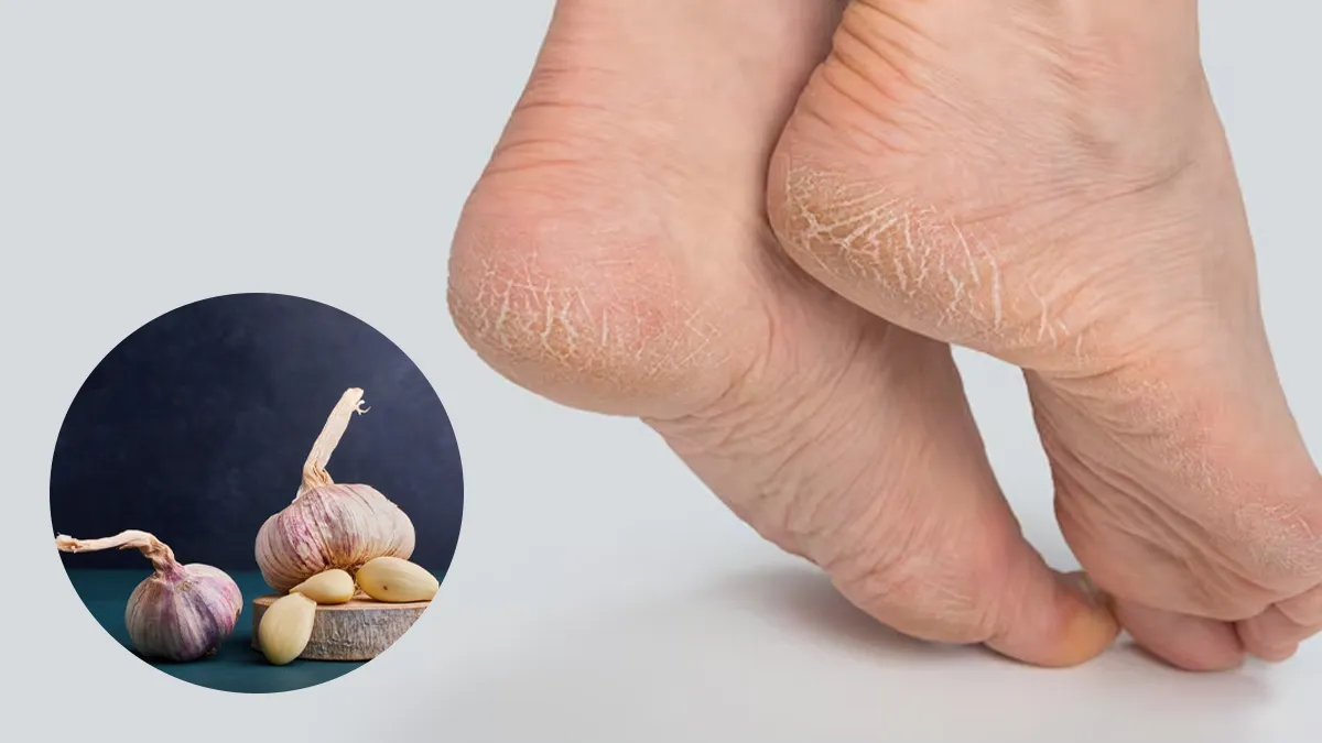घी में मिलाकर लगाएं लहसुन की मात्र 2 कली, रातों-रात फटी एड़ियों का होगा कायाकल्प