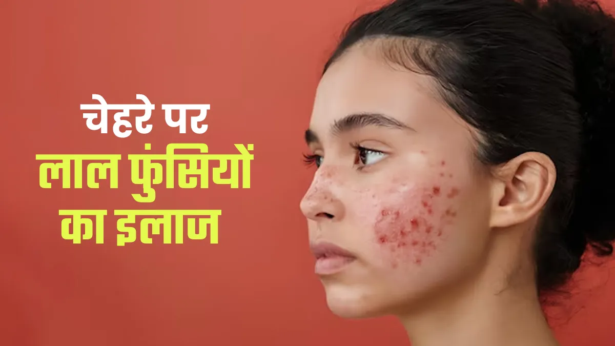 लाल फुंसियों से भर गया है चेहरा? डर्मेटोलॉज‍िस्‍ट से जानें सही इलाज
