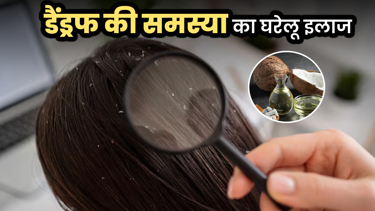 डैंड्रफ की समस्या से हैं परेशान? नारियल तेल में मिलाकर लगा लें ये 3 चीजें