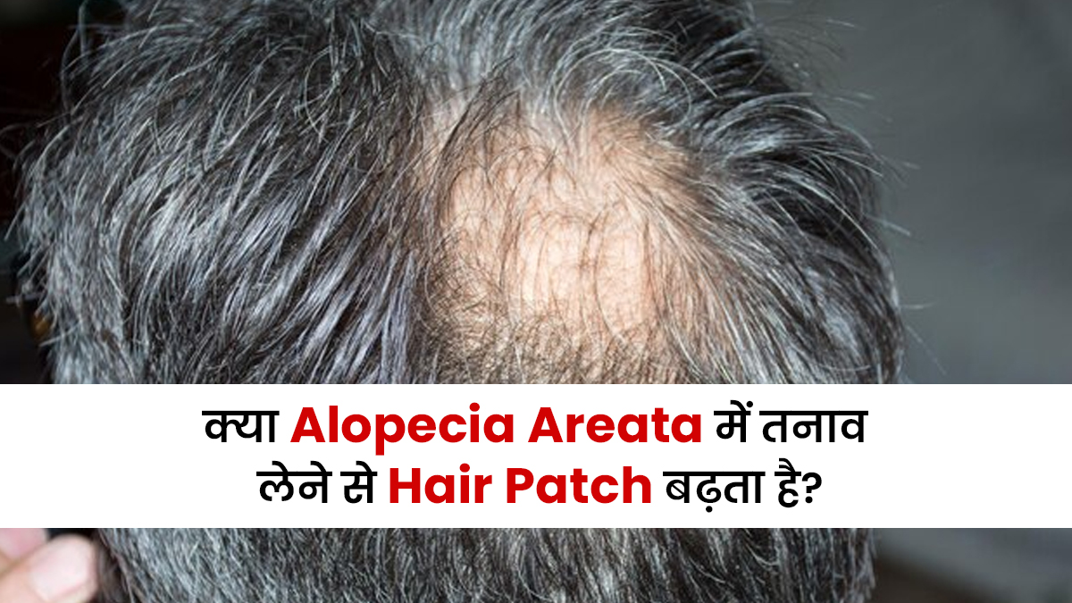 क्या एलोपेसिया एरीटा में तनाव लेने से Hair Patch बढ़ सकता है? जानें क्या कहते हैं डॉक्टर