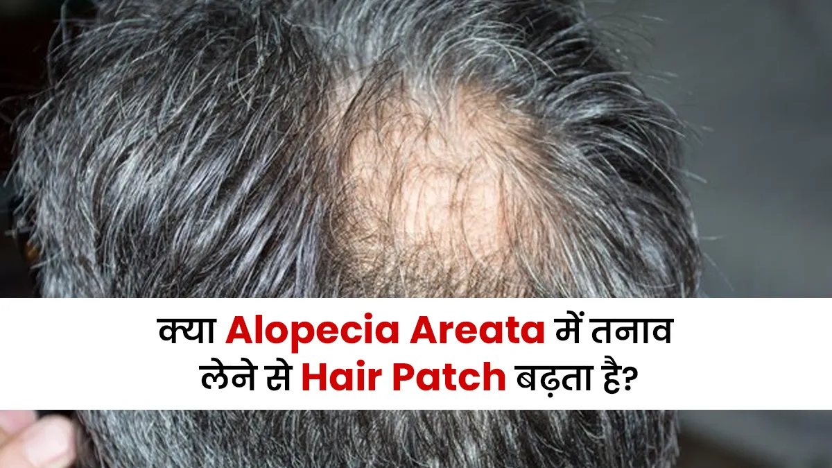 क्या एलोपेसिया एरीटा में तनाव लेने से Hair Patch बढ़ सकता है? जानें क्या कहते हैं डॉक्टर