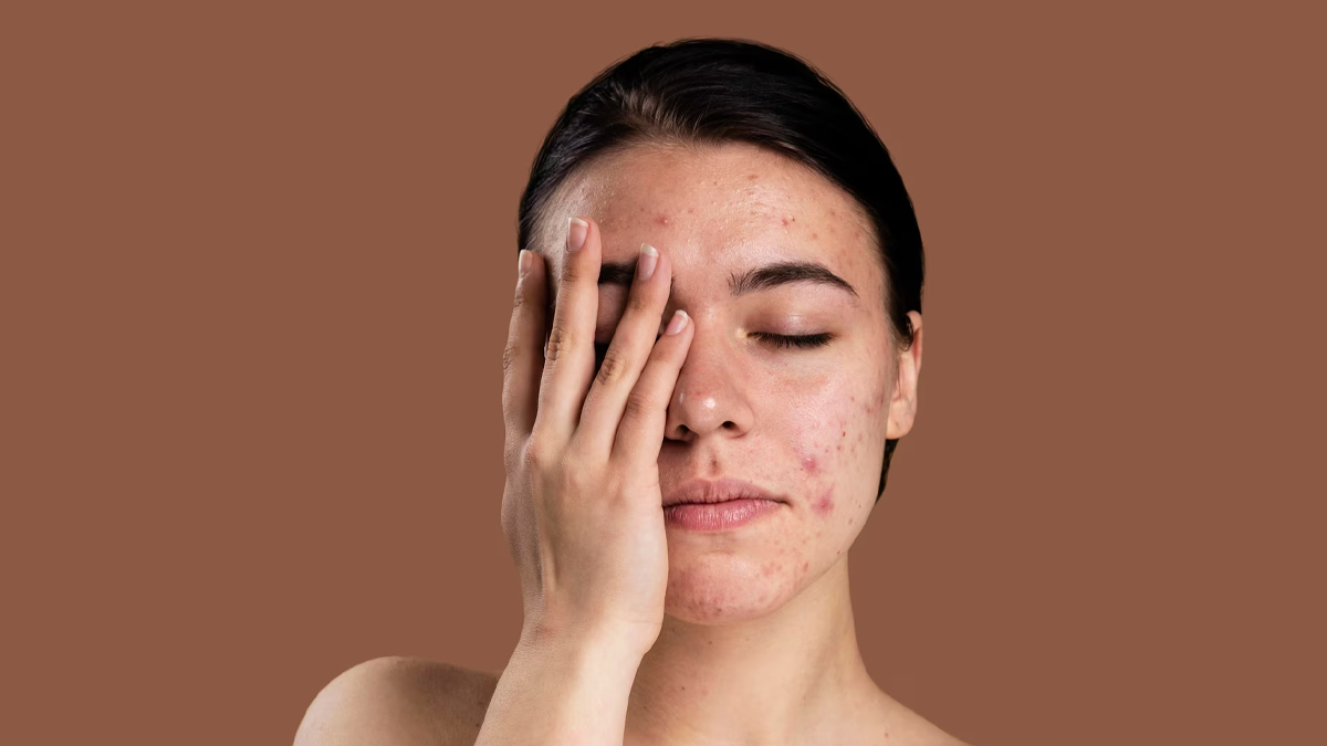 how to clean oily and acne prone skin in winter in hindi 01 (5)