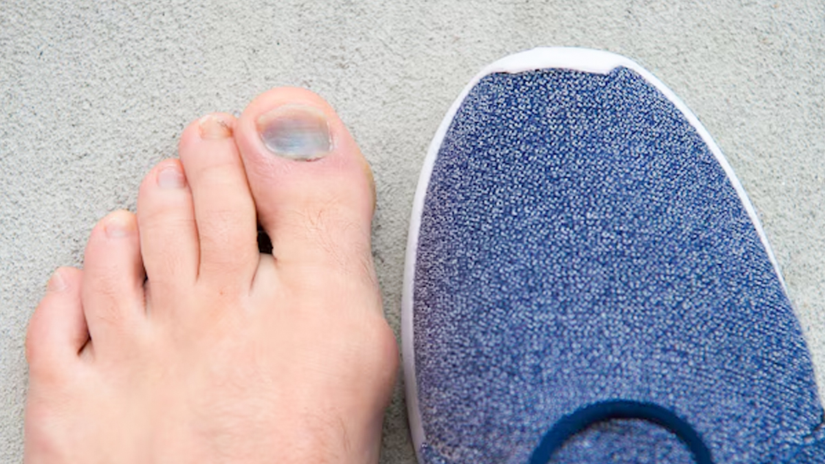 why do toes turn blue doctor explains in hindi 1