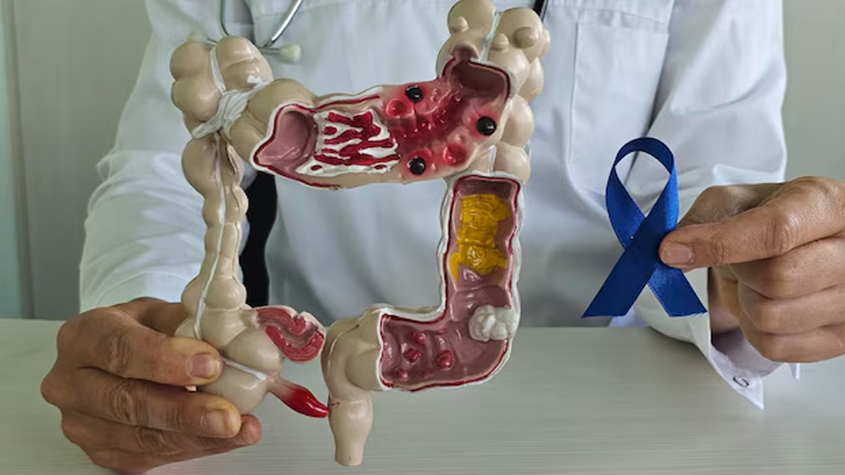 Is colon cancer hereditary