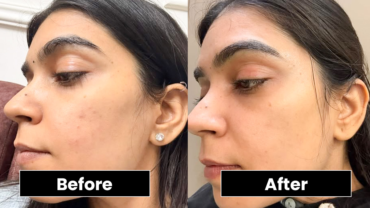 pigmentation-remedy-results